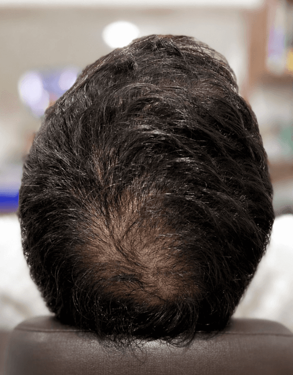 Coroa de um homem antes do tratamento, com rarefação no alto da cabeça