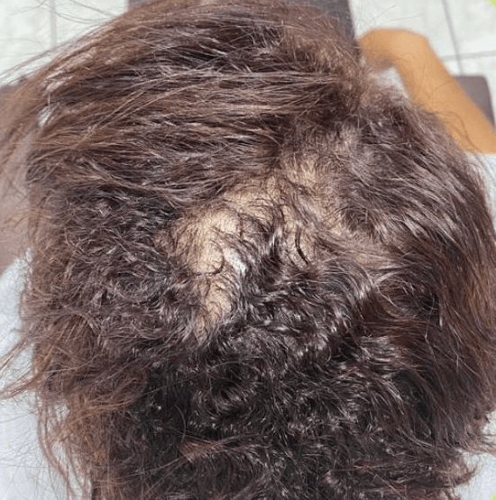 Topo de uma cabeça de cabelo cacheado antes do tratamento, com uma falha arredondada de fios