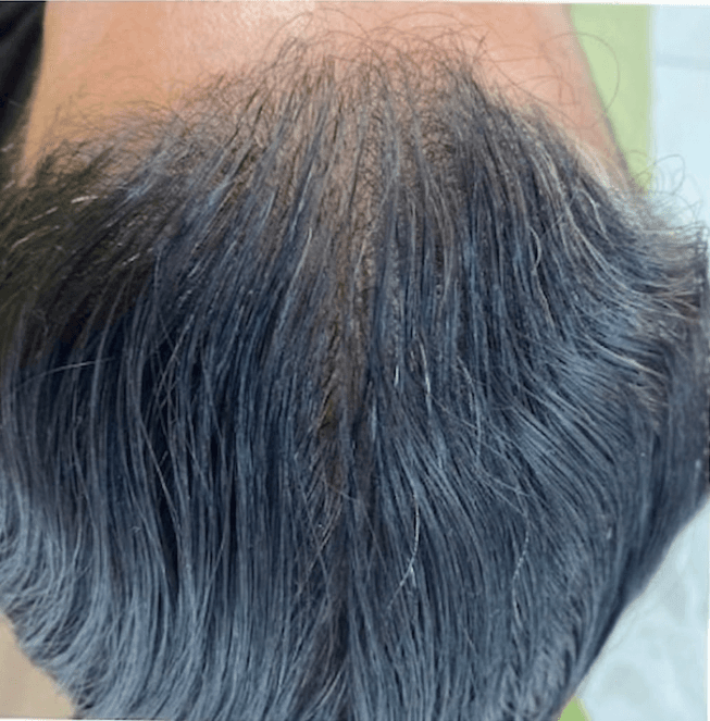 Linha frontal do cabelo antes do tratamento, com fios ralos e o couro cabeludo aparecendo