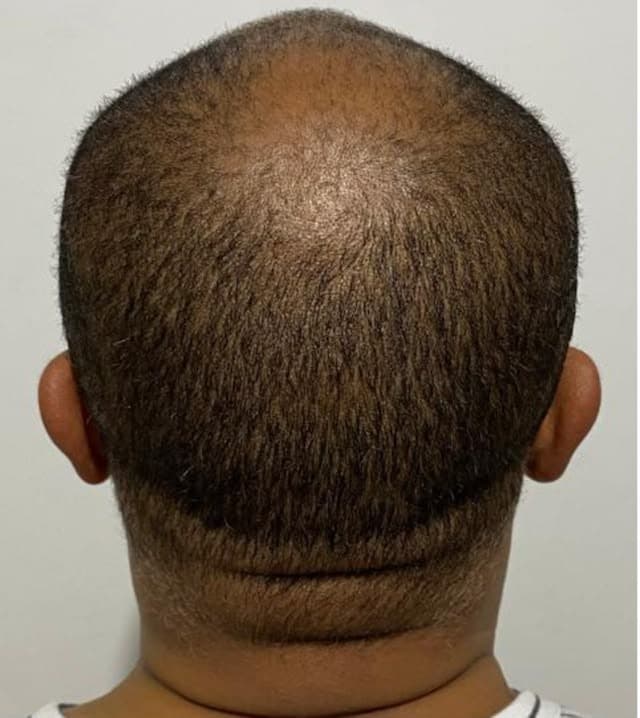 Nuca de um homem antes do tratamento, com falha de densidade no alto